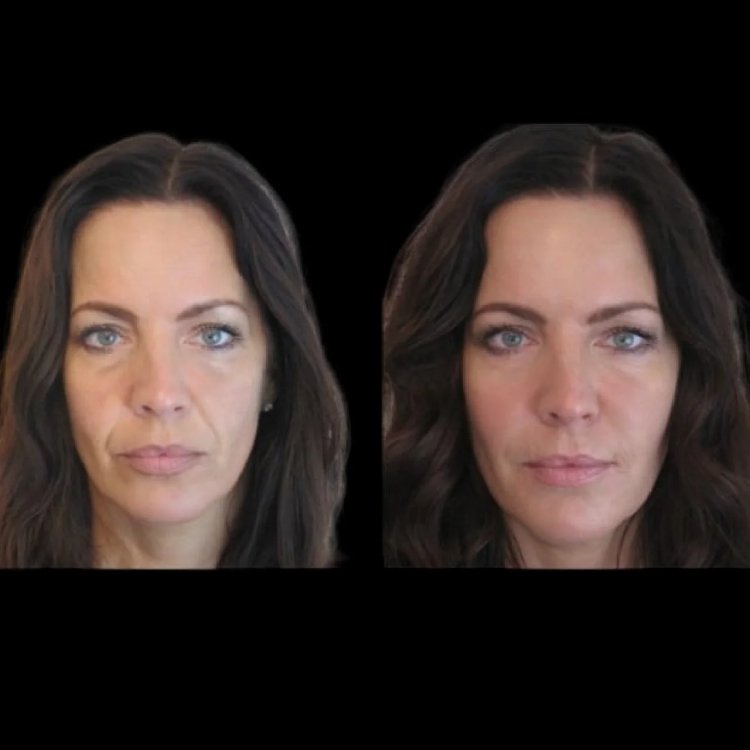 Cost of Jawline Fillers with the Best Plastic Surgeons in Dubai – What to Expect