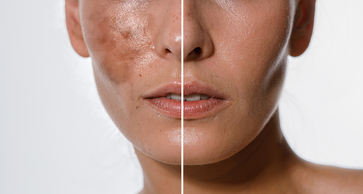 Islamabad Can Transform Your Skin Safely and Effectively 1 Islamabad Can Transform Your Skin Safely and Effectively