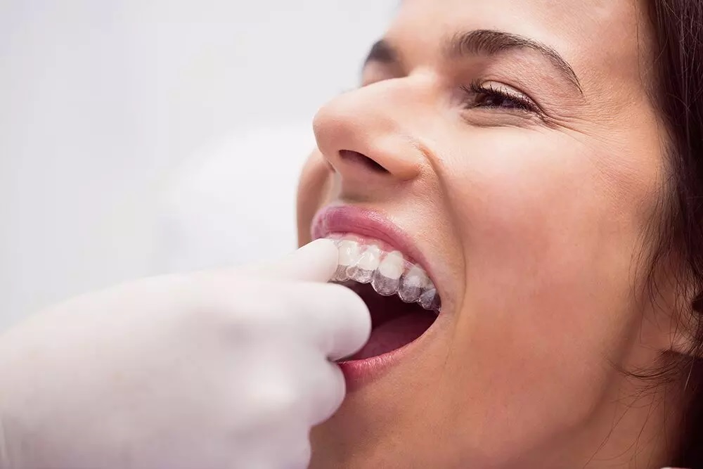 How Do Clear Teeth Aligners in Houston Compare to Traditional Braces?