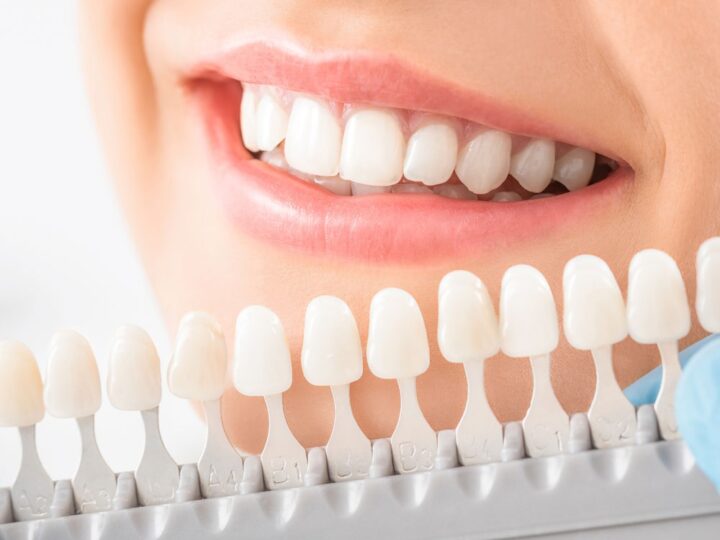 Are There Affordable Dental Veneer Specialists Near Me?