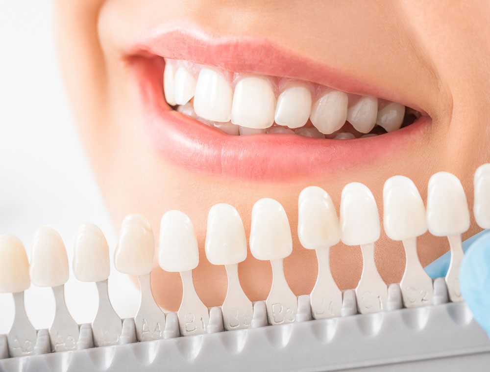 Are There Affordable Dental Veneer Specialists Near Me?