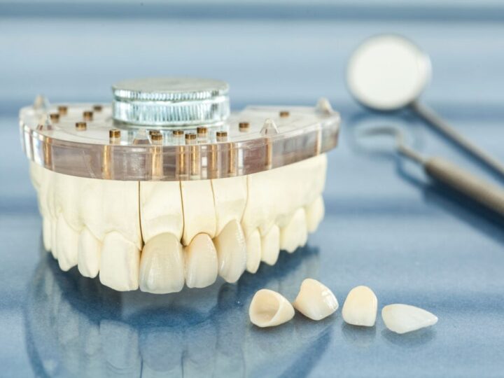 How Much Do Veneers Cost in Houston, Texas?