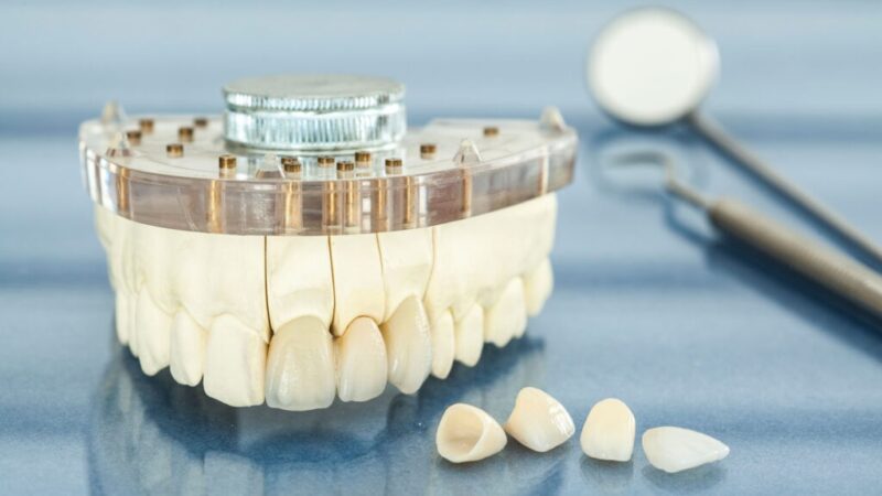 How Much Do Veneers Cost in Houston, Texas?