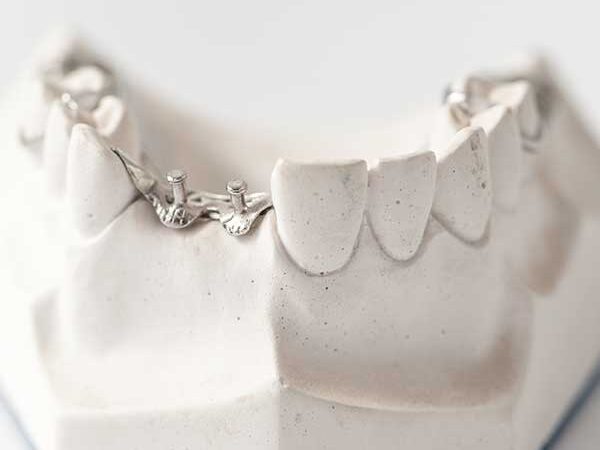 What Are the Different Types of Dental Implants Available?