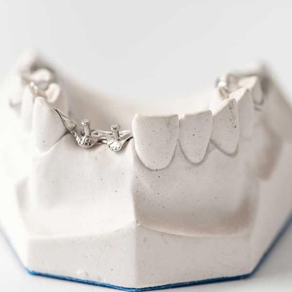 What Are the Different Types of Dental Implants Available?