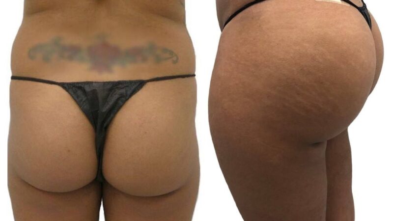 Why Do People Choose a Brazilian Butt Lift Over Implants?