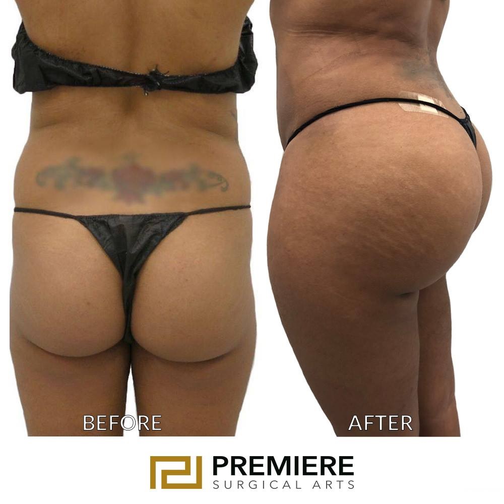 Why Do People Choose a Brazilian Butt Lift Over Implants?