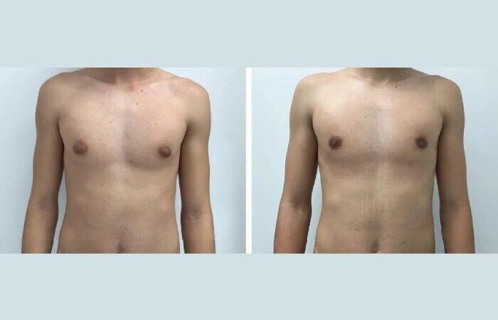 Gynecomastia Surgery in dubai: Expert Insights for Male Chest Reduction
