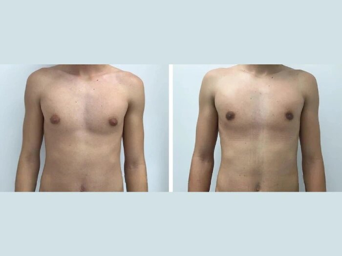 Gynecomastia Surgery in dubai: A Complete Guide for Men
