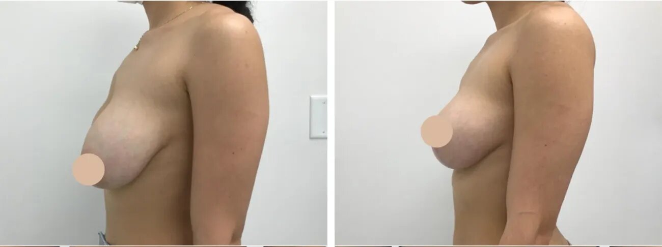 Breast Lift Surgery in dubai: Enhancing Shape and Firmness with Precision