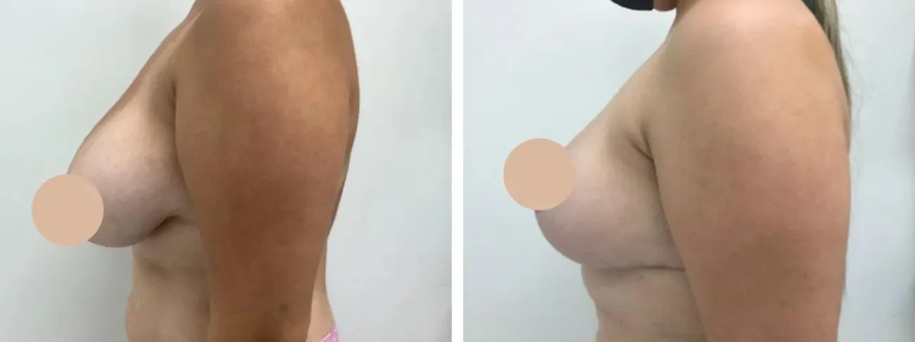 Building Realistic Expectations Before Breast Reduction Surgery in dubai