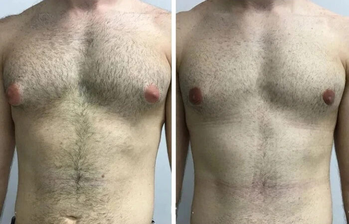 Gynecomastia Surgery in dubai: Expert Guide to Male Chest Reduction