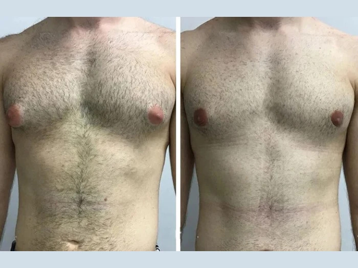 Gynecomastia Surgery in dubai: The Modern Male Chest Transformation