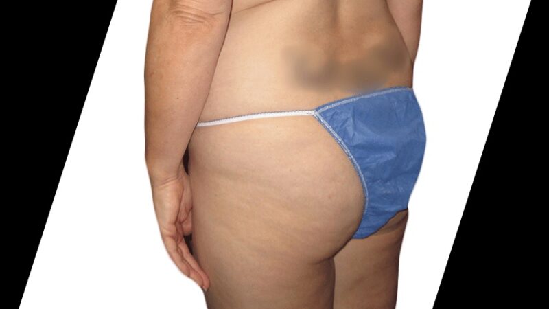 How Do You Choose the Best Surgeon for Liposuction in Houston?