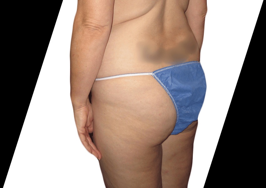 How Do You Choose the Best Surgeon for Liposuction in Houston?