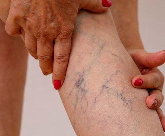 Why Should You Choose California Vein Experts for Vein Care?