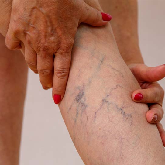 Why Should You Choose California Vein Experts for Vein Care?