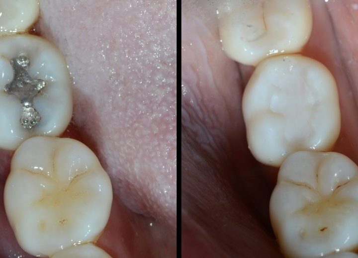 Are you looking for the safest dental filling in Islamabad to restore your teeth effectively?