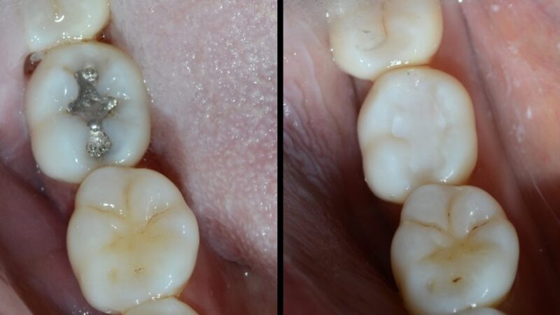 Are you looking for the safest dental filling in Islamabad to restore your teeth effectively?