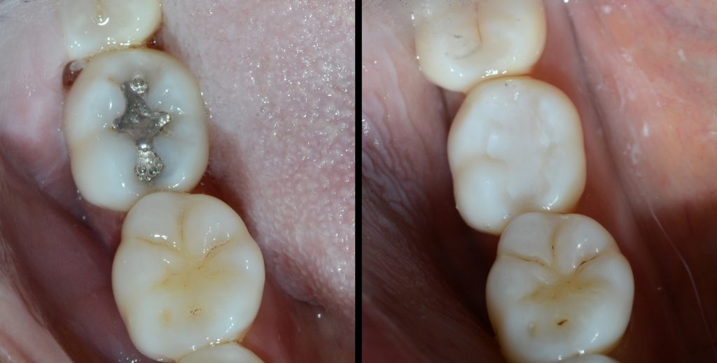 Are you looking for the safest dental filling in Islamabad to restore your teeth effectively?