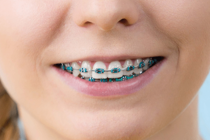 Transform your smile with top dental braces Singapore