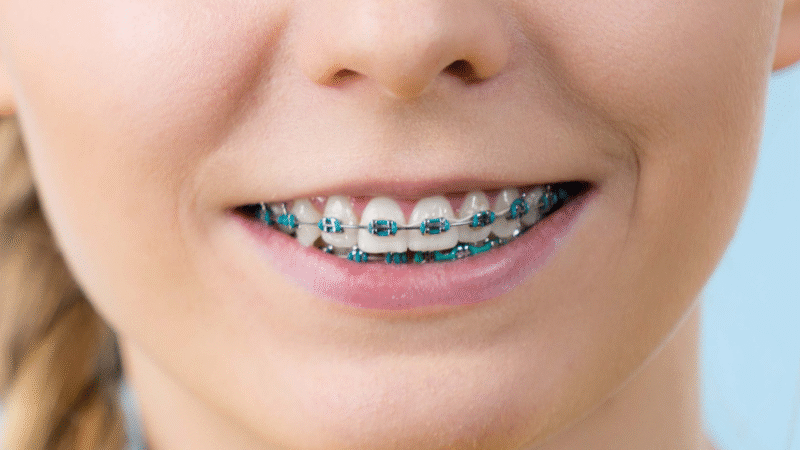 Transform your smile with top dental braces Singapore
