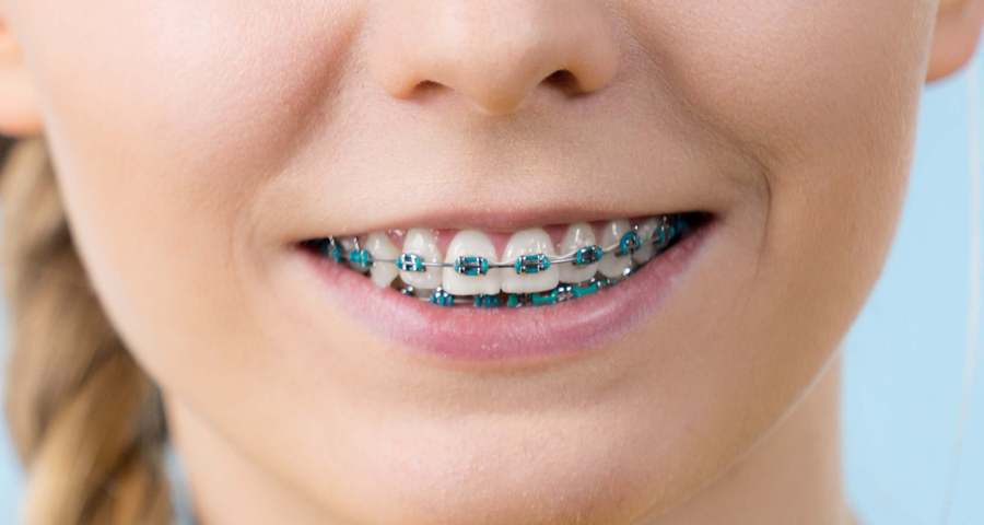 Transform your smile with top dental braces Singapore