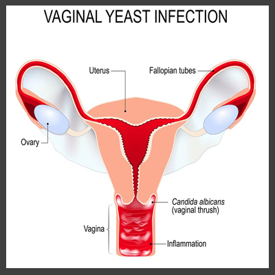 Understanding the Importance of Medical Insurance Plans for Women with Recurrent Vaginal Yeast Infections