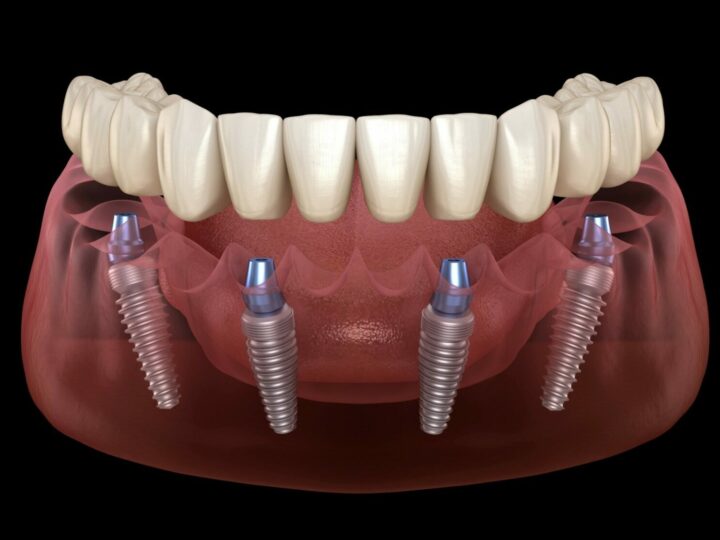 How Do I Choose the Best Place for Dental Implants?