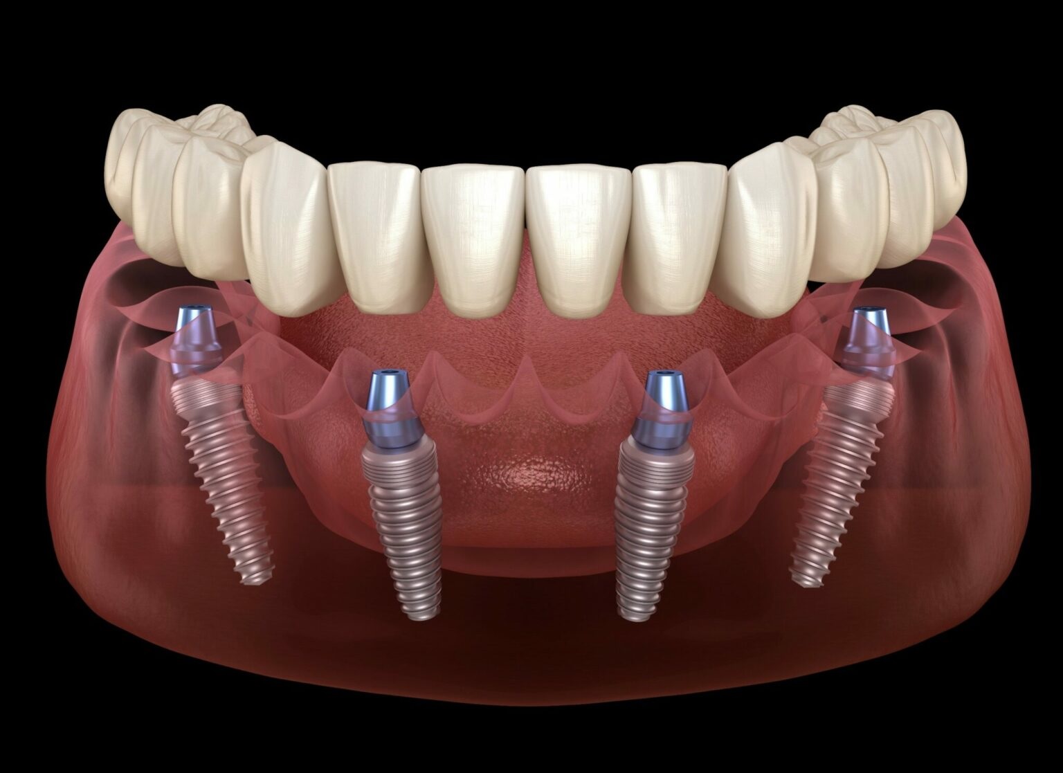 How Do I Choose the Best Place for Dental Implants? 1 How Do I Choose the Best Place for Dental Implants?