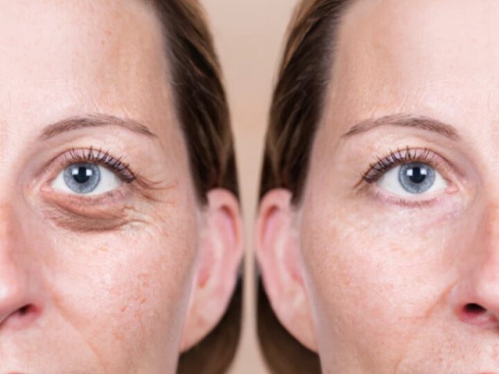 What Are the Benefits of Eyelid Surgery?