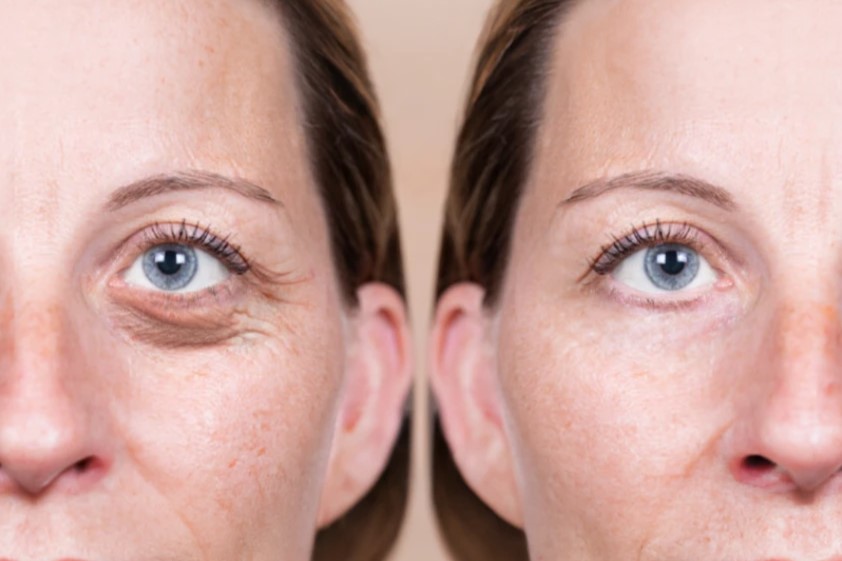 What Are the Benefits of Eyelid Surgery? 1 What Are the Benefits of Eyelid Surgery?