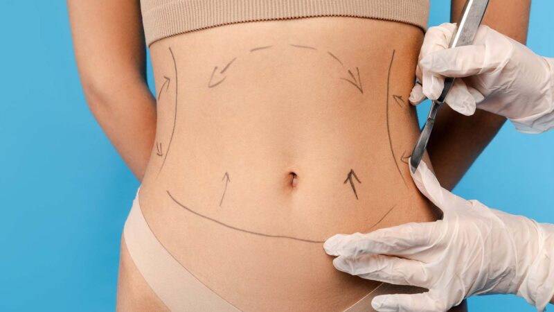 Liposuction vs Tummy Tuck Which One Is Right for You
