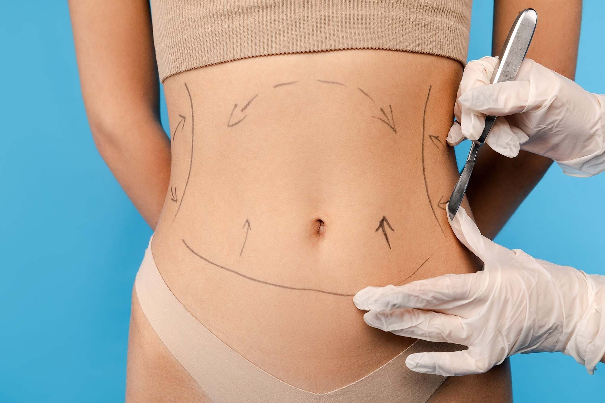 Liposuction vs Tummy Tuck Which One Is Right for You 1 Liposuction vs Tummy Tuck Which One Is Right for You