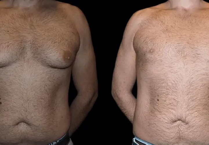 Gynecomastia Surgery in Dubai: Clothing and Compression Garment Guide