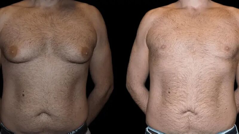 Gynecomastia Surgery in Dubai: Clothing and Compression Garment Guide