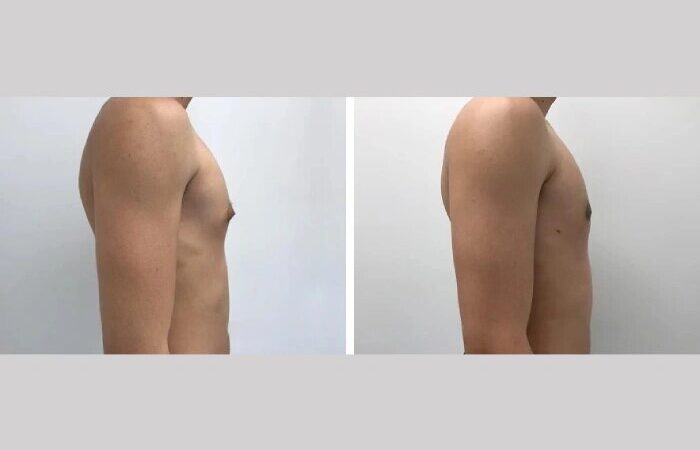 Best Gynecomastia Surgeons in dubai for Liposuction-Assisted Surgery