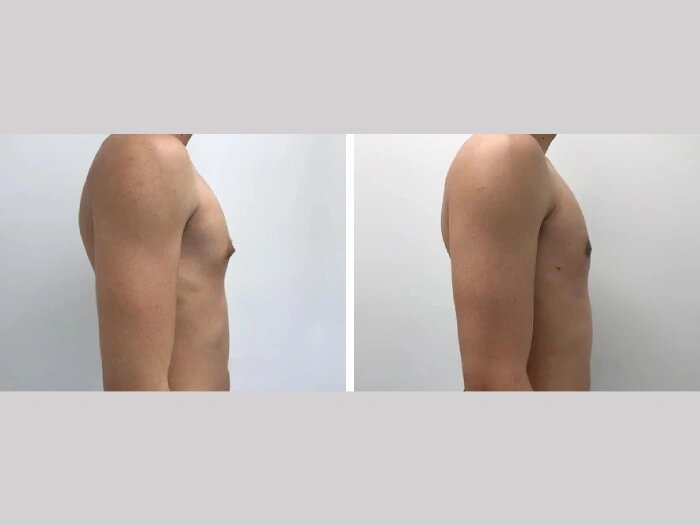 Best Gynecomastia Surgeons in dubai for Liposuction-Assisted Surgery 1 Best Gynecomastia Surgeons in dubai for Liposuction-Assisted Surgery