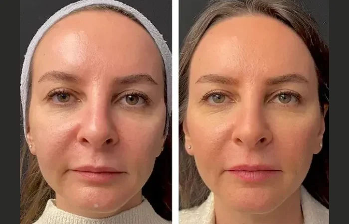 Mesotherapy Treatment in Dubai for Pre-Bridal Glow