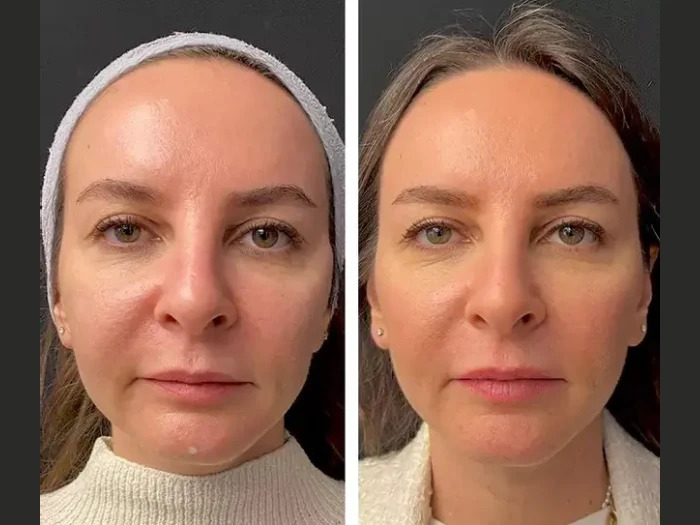 Affordable Clinics with Best Doctors in Dubai for Mesotherapy