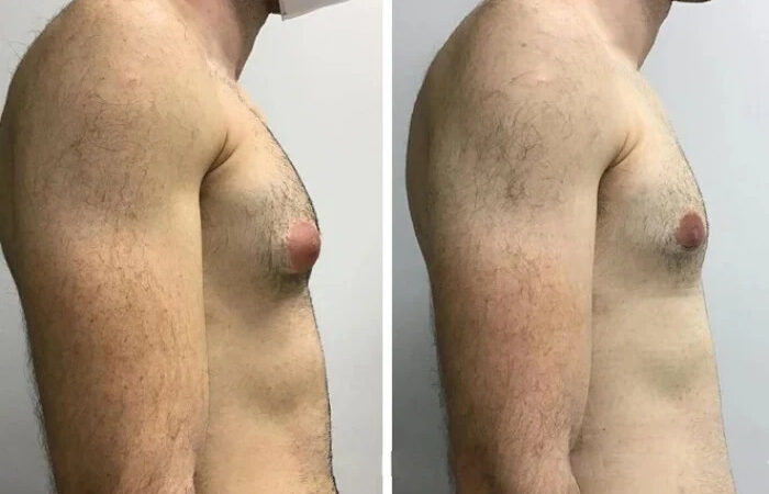 Gynecomastia Surgery in dubai: Permanent Solution to Man Boobs