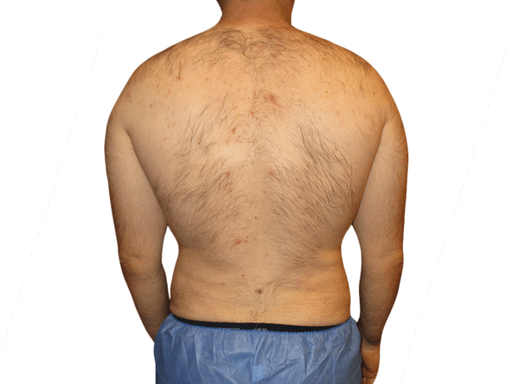 What Should You Know Before Getting Liposuction in Houston?