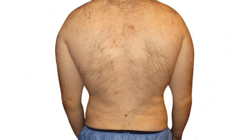 What Should You Know Before Getting Liposuction in Houston?
