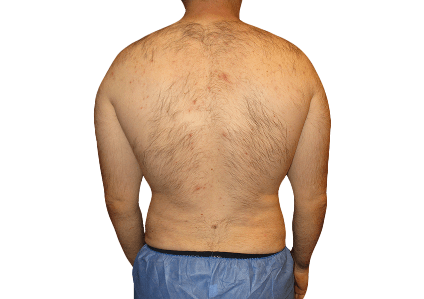 What Should You Know Before Getting Liposuction in Houston?