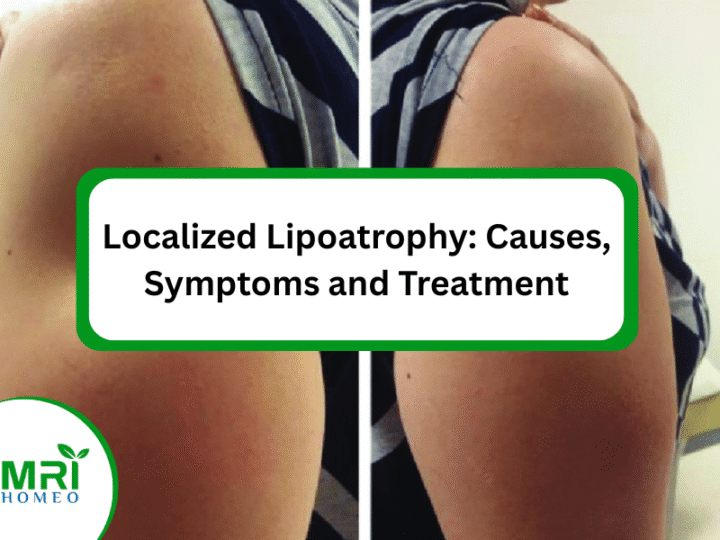 Localized Lipoatrophy: Causes, Symptoms and Treatment