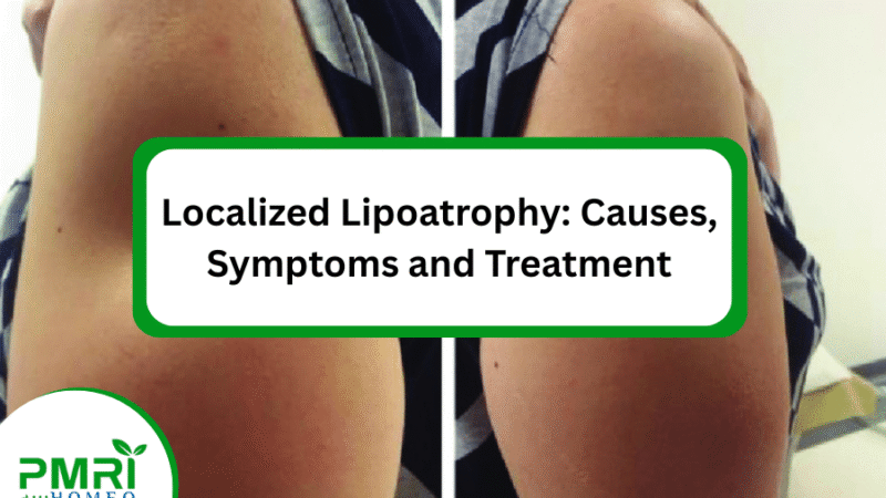 Localized Lipoatrophy: Causes, Symptoms and Treatment