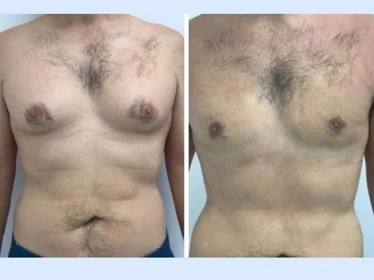 How Advanced Techniques Are Used by Best Gynecomastia Surgeons in Dubai 1 How Advanced Techniques Are Used by Best Gynecomastia Surgeons in Dubai